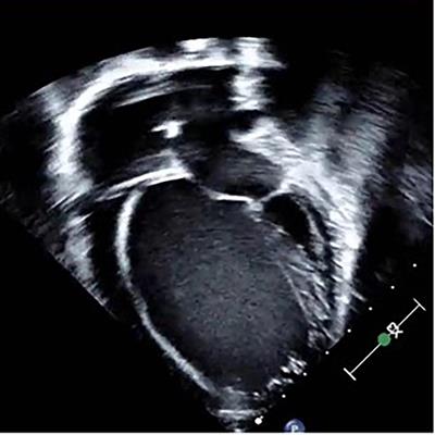 Clinical Insights Into Heritable Cardiomyopathies